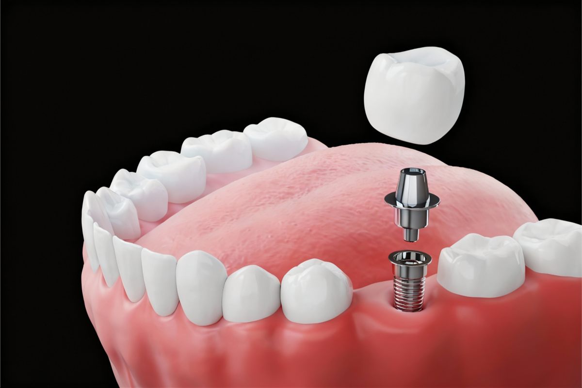Dental Implants for Lemoore, CA patients at Fresno Dental Care