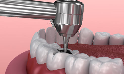 Root Canals for Lemoore, CA patients at Fresno Dental Care