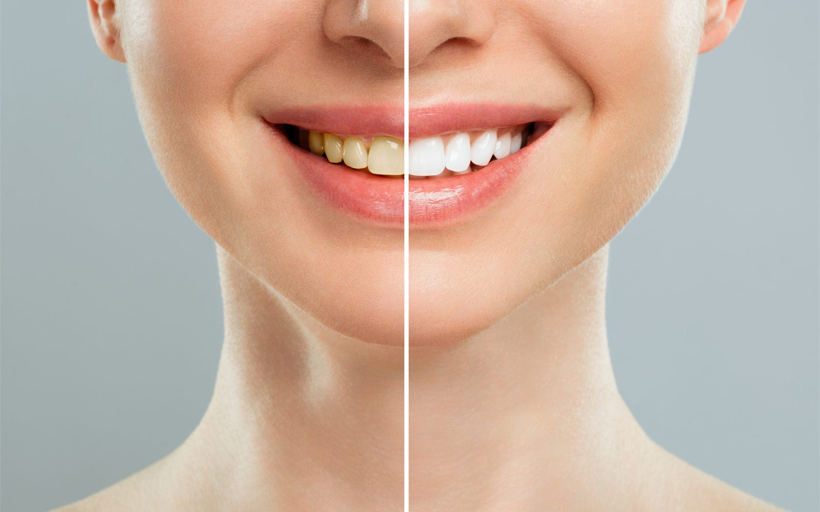 Before and after professional teeth whitening results at a Fresno, CA dental clinic