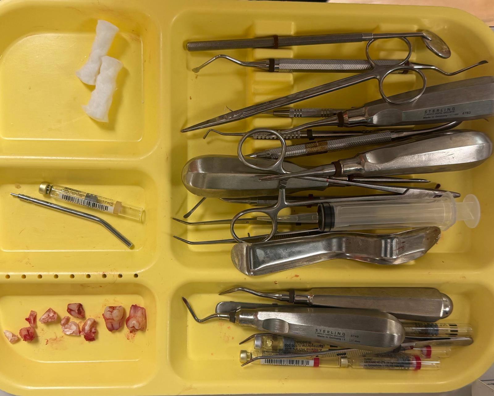 Wisdom Tooth Extractions for Lemoore, CA patients at Fresno Dental Care