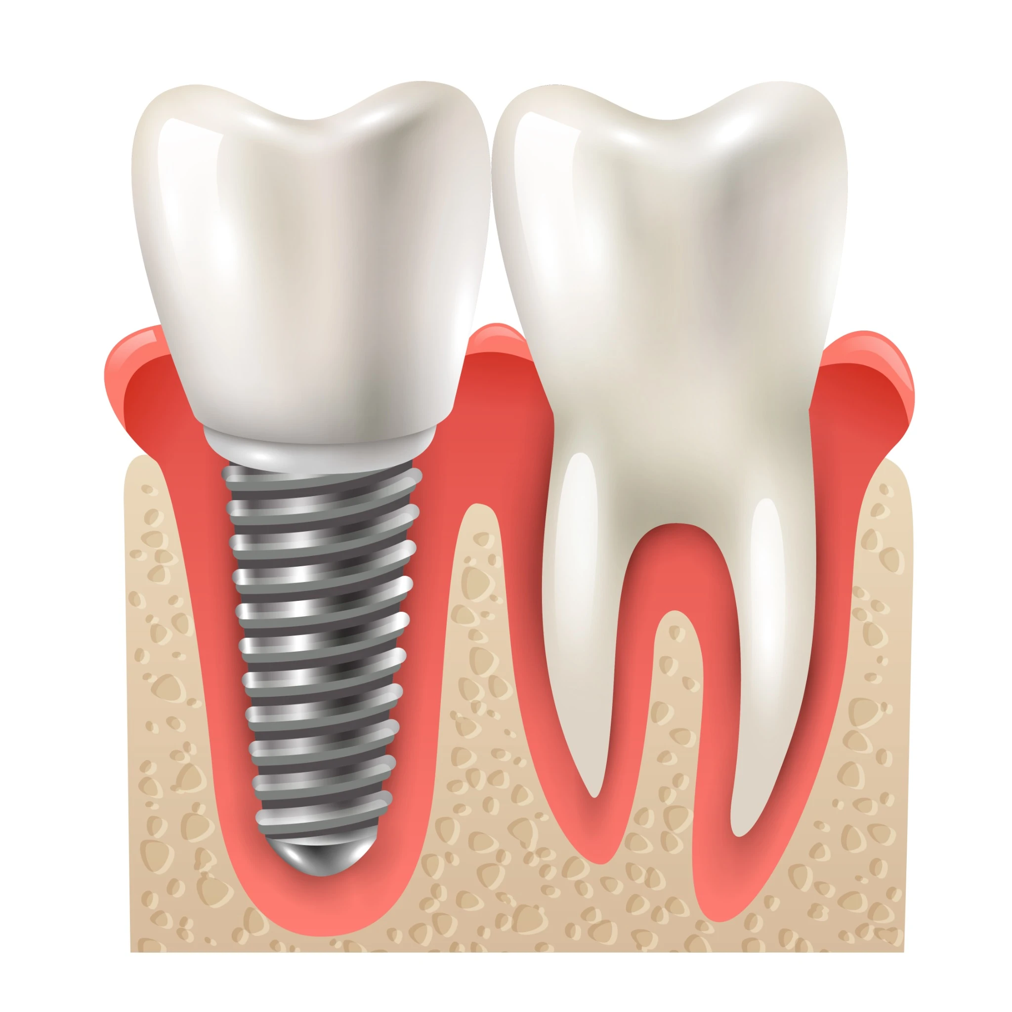 Diagram of dental implant next to natural tooth structure