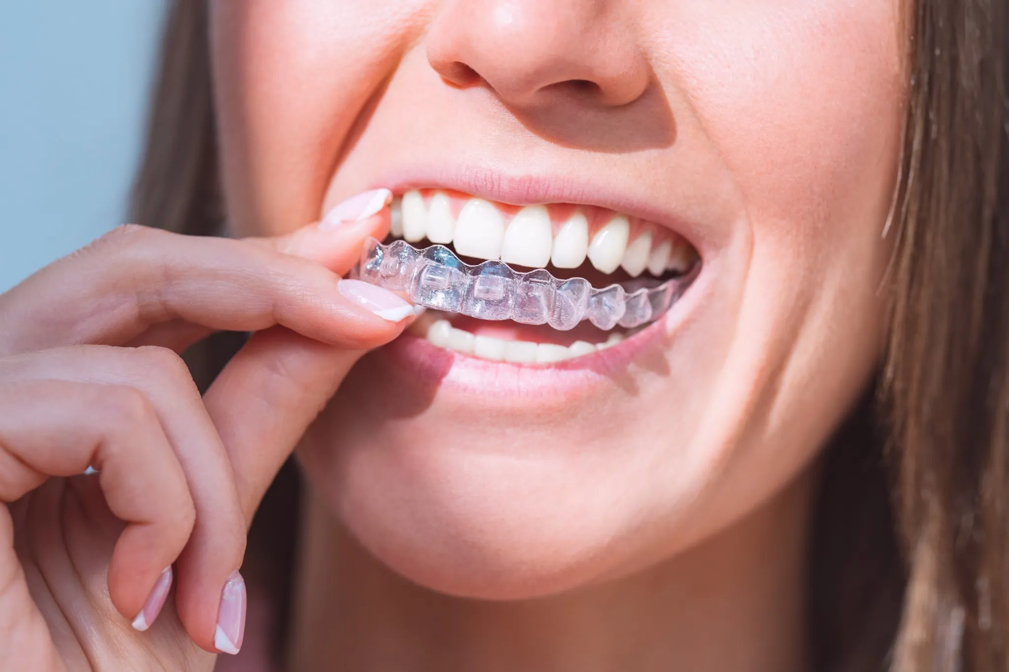 Blog 18 Woman inserting a clear custom dental mouthguard for teeth protection