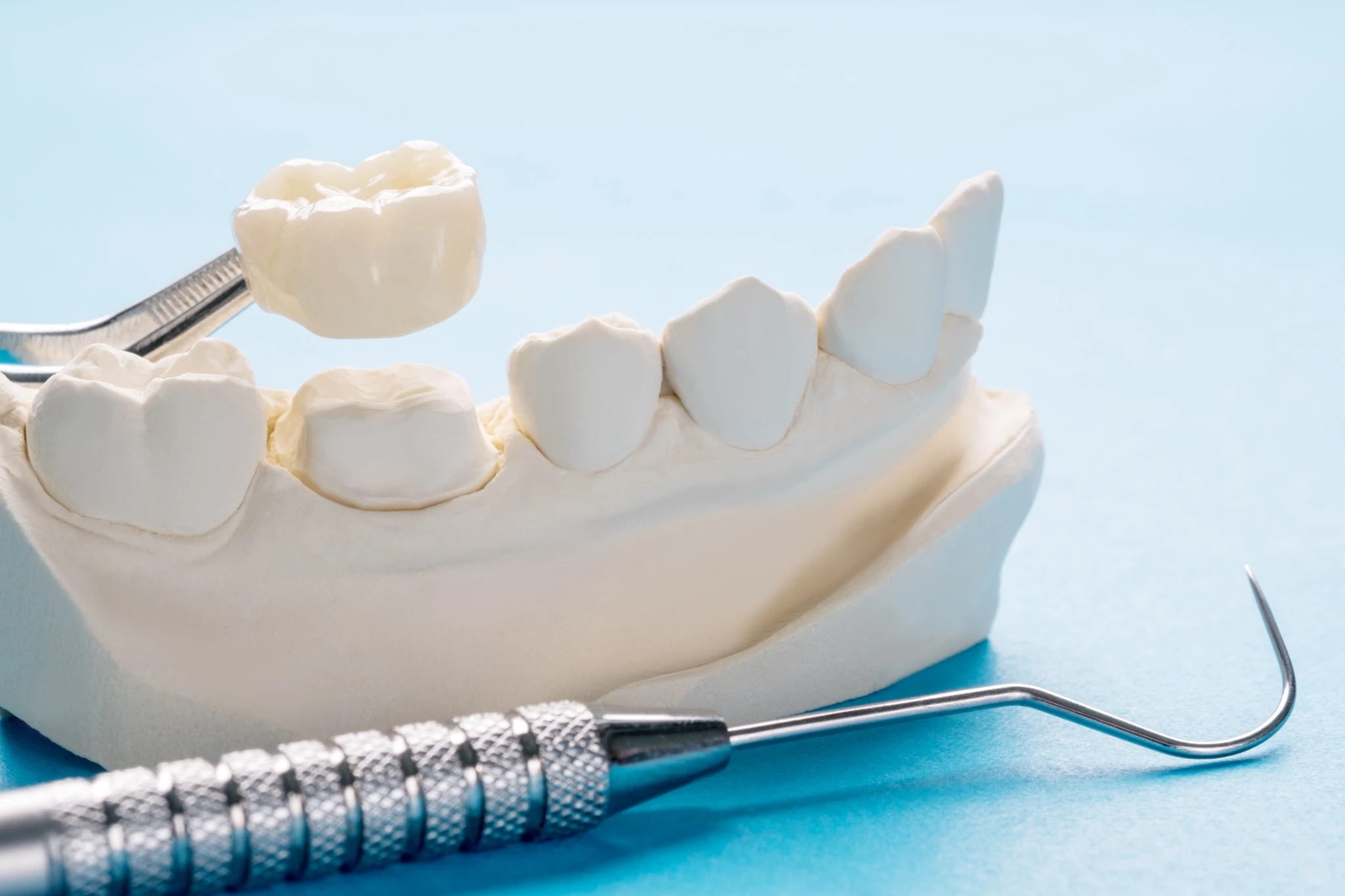 Close-up of a dental crown being placed on a molar model, representing restorative dentistry in Fresno