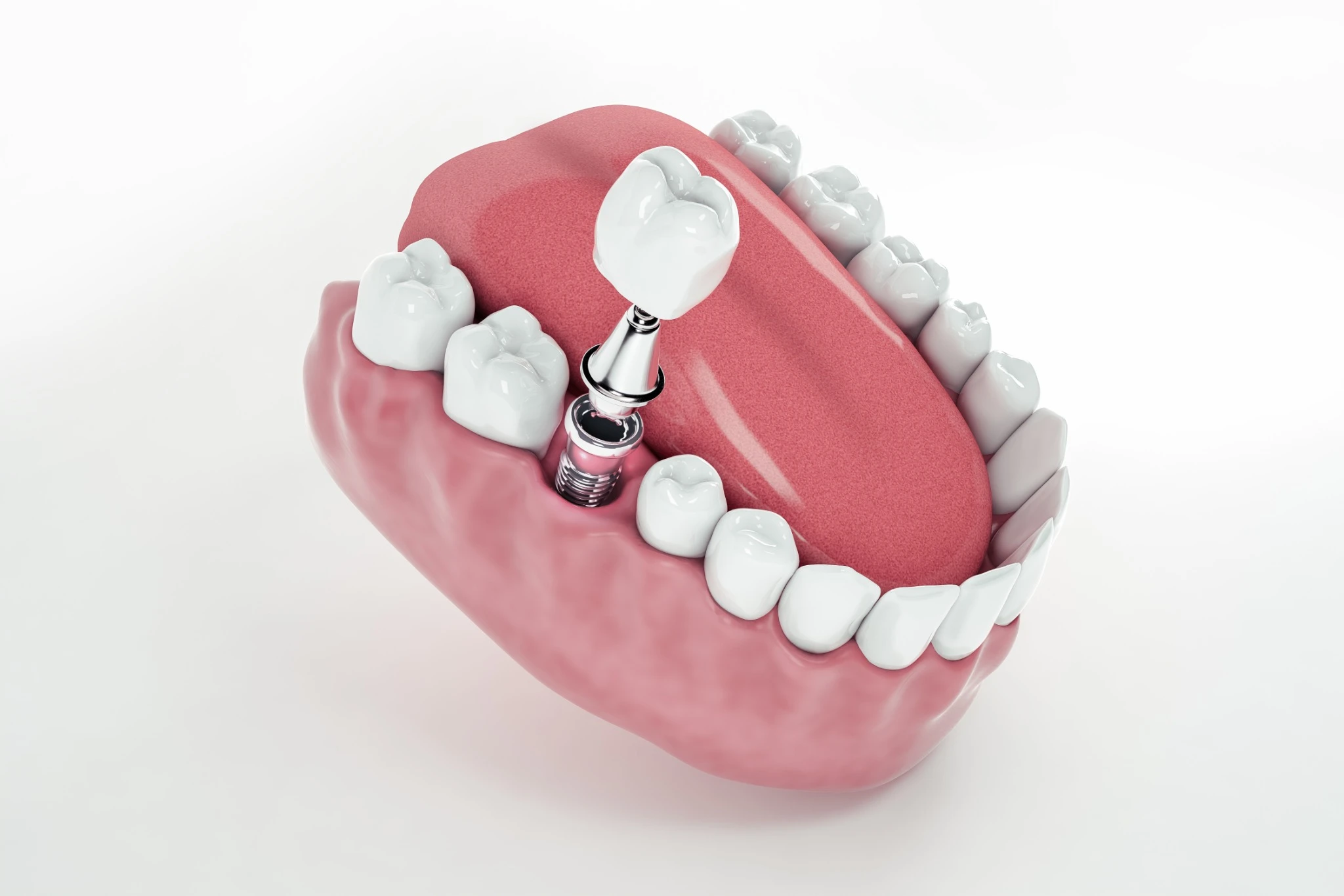 View of dental implant secured in jawbone