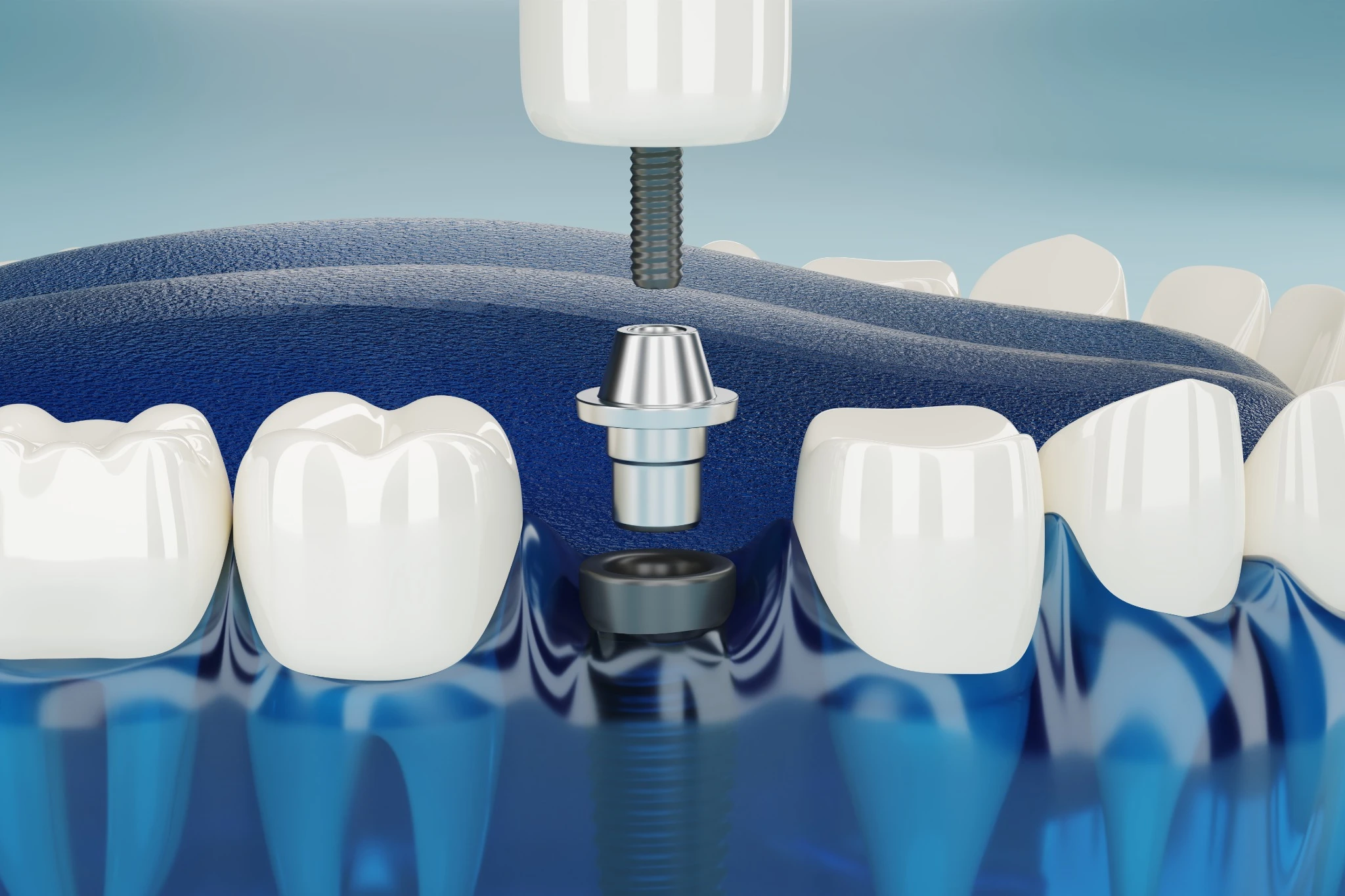 Tooth implant illustration showing crown and screw