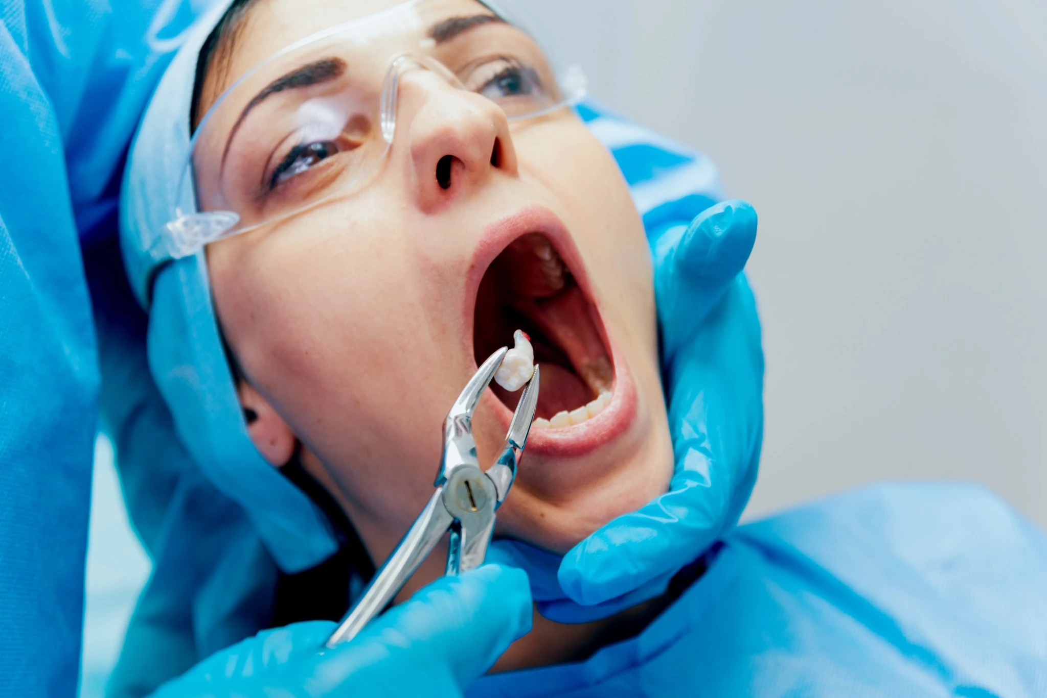 Tooth being removed using surgical pliers