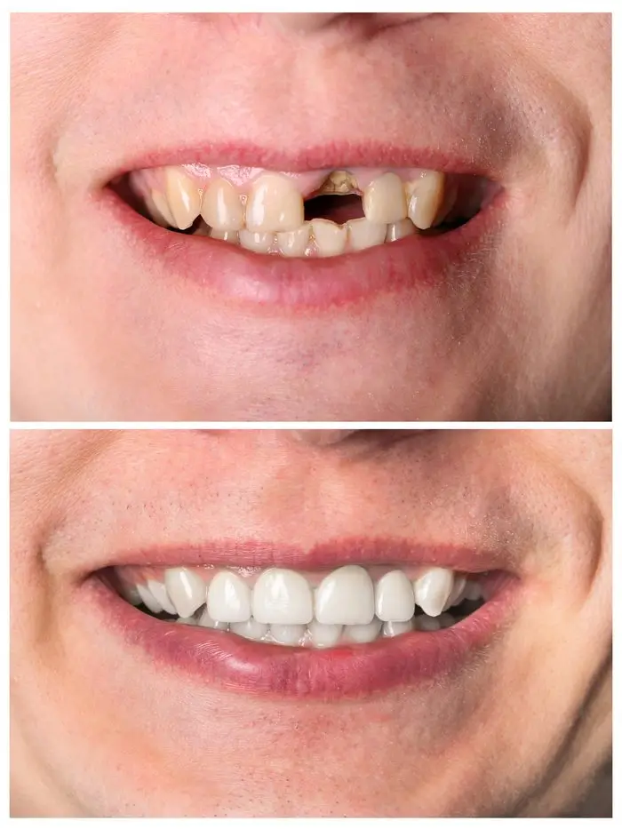 Before and after dental implant result at Fresno Dental Care Fresno CA 93710