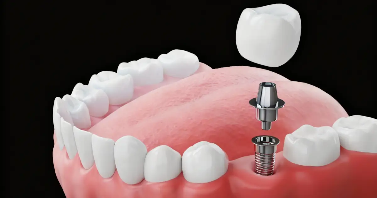 How Much Do Dental Implants Cost in Fresno, CA?